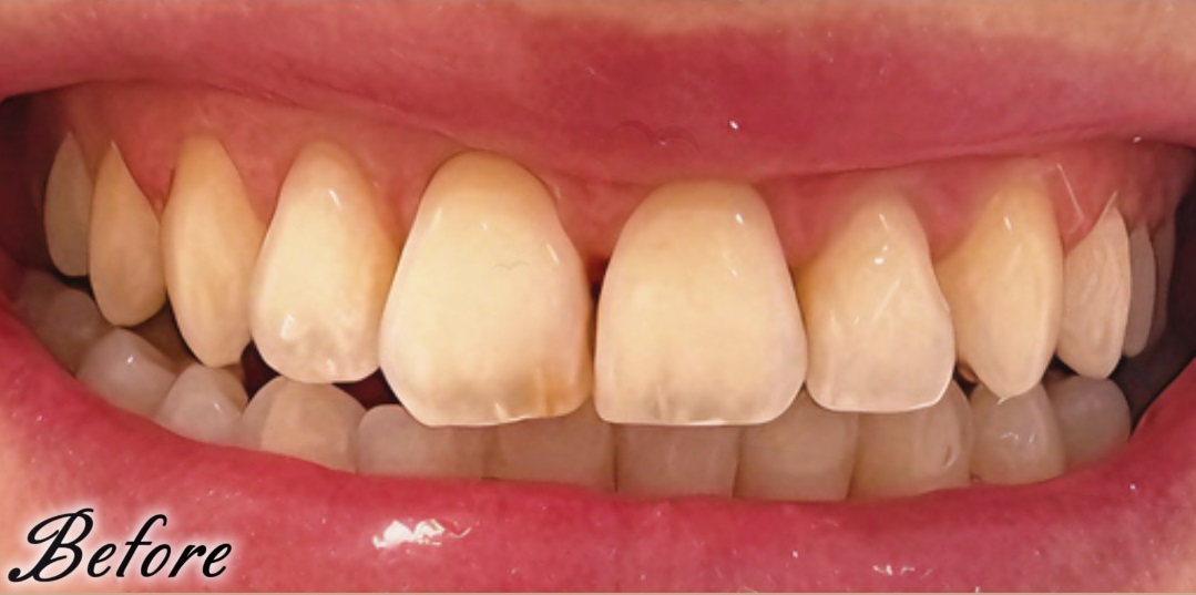 before image