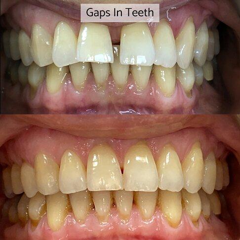 Invisalign before and after results Richmond London — Case 3