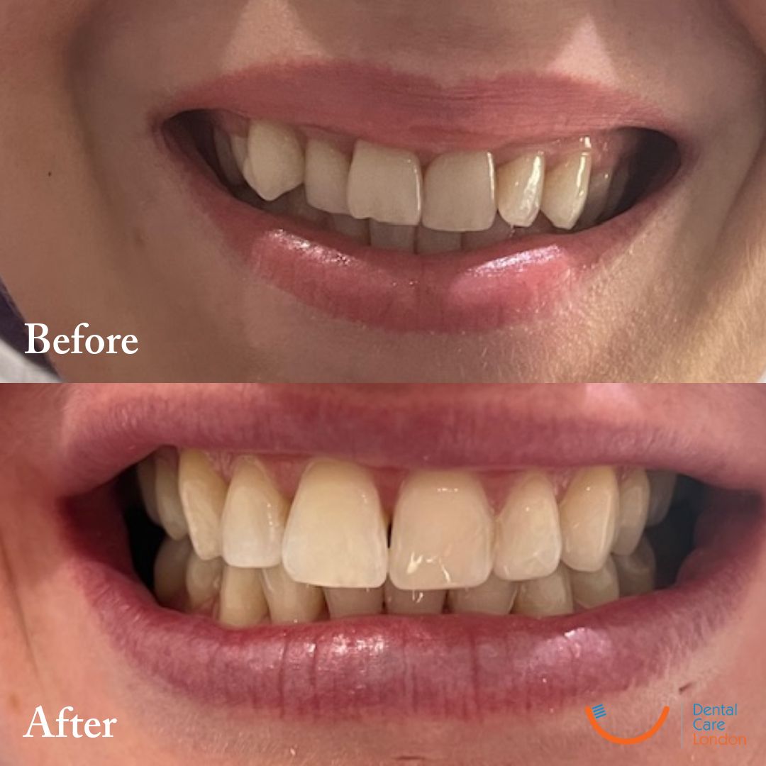 Invisalign before and after results Richmond London — Case 4