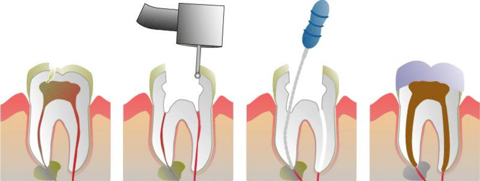 Root-Canal-Therapy-Steps