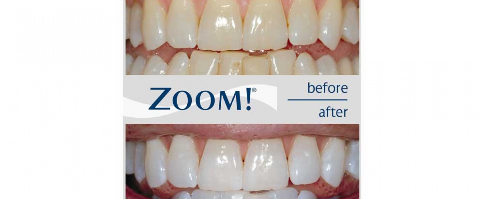 price of zoom teeth whitening